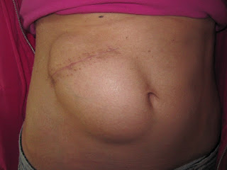 Jamie Hilton skull being stored in her abdomen